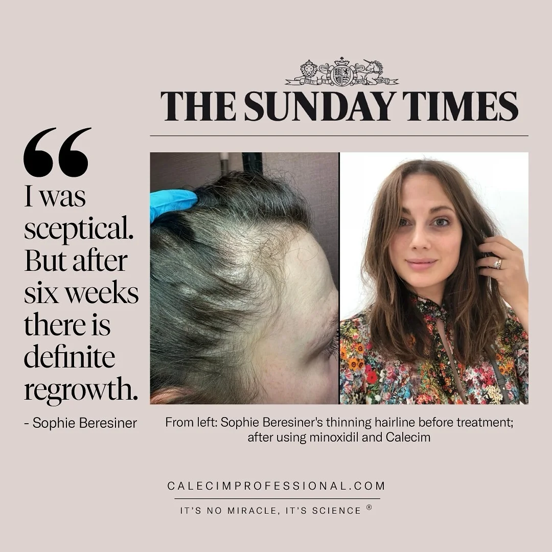 CALECIM Professional before-and-after hair regrowth ad: side-by-side photos of a thinning hairline and full restored hair under a Sunday Times masthead, with the customer quote 'I was sceptical. But after six weeks there is definite regrowth.'